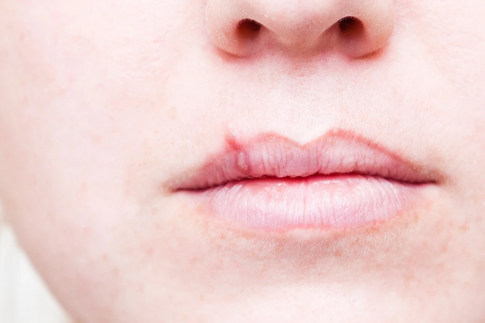 Cold sore on lip